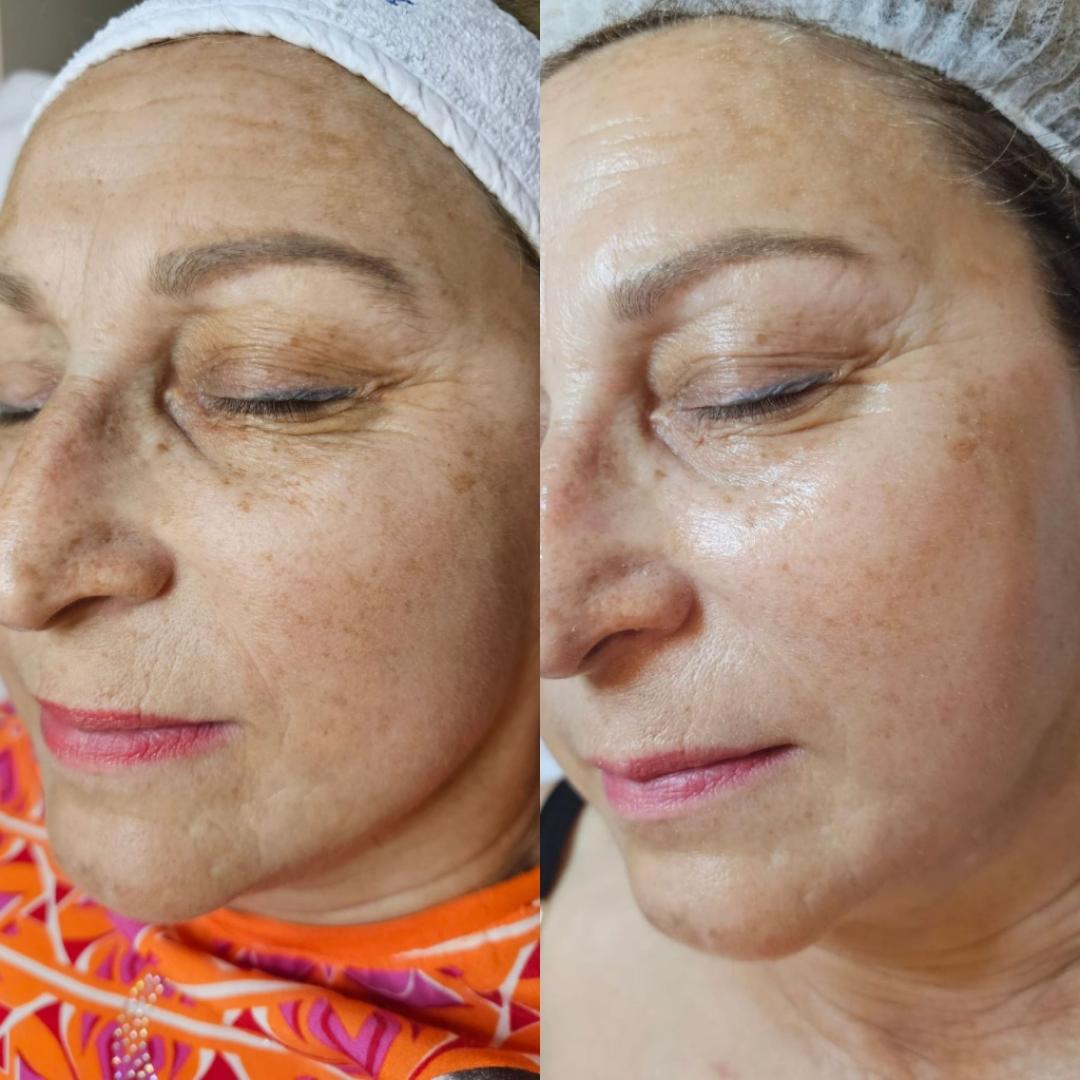 Choco Love #beograd Tretman lica Green peel - Energy