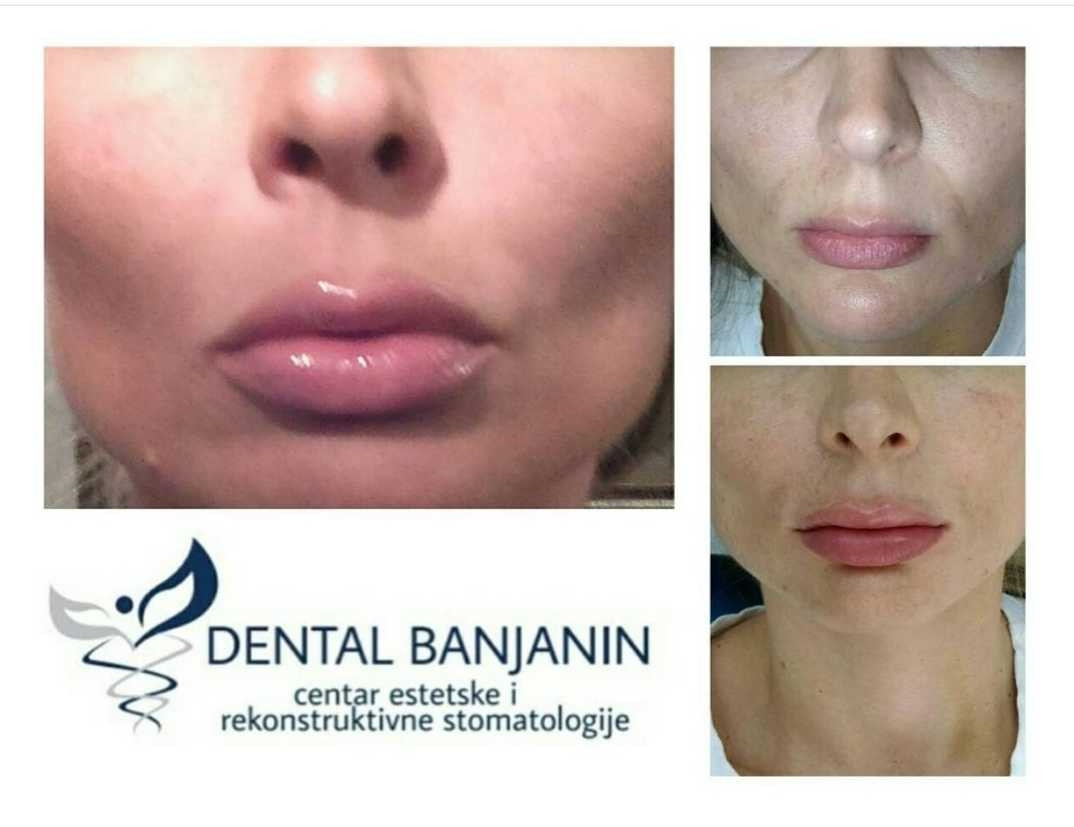 Ordinacija Dr Bojana Banjanin #beograd Dermalni fileri
