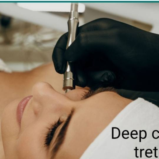 Laser centar Delight #beograd Piling lica Deep clean tretman lica + UZ špatula + mikrodermoabrazija
