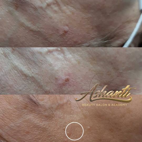 Ashanti Beauty Salon & Academy #beograd Tretman lica Uklanjanje virusnih bradavica