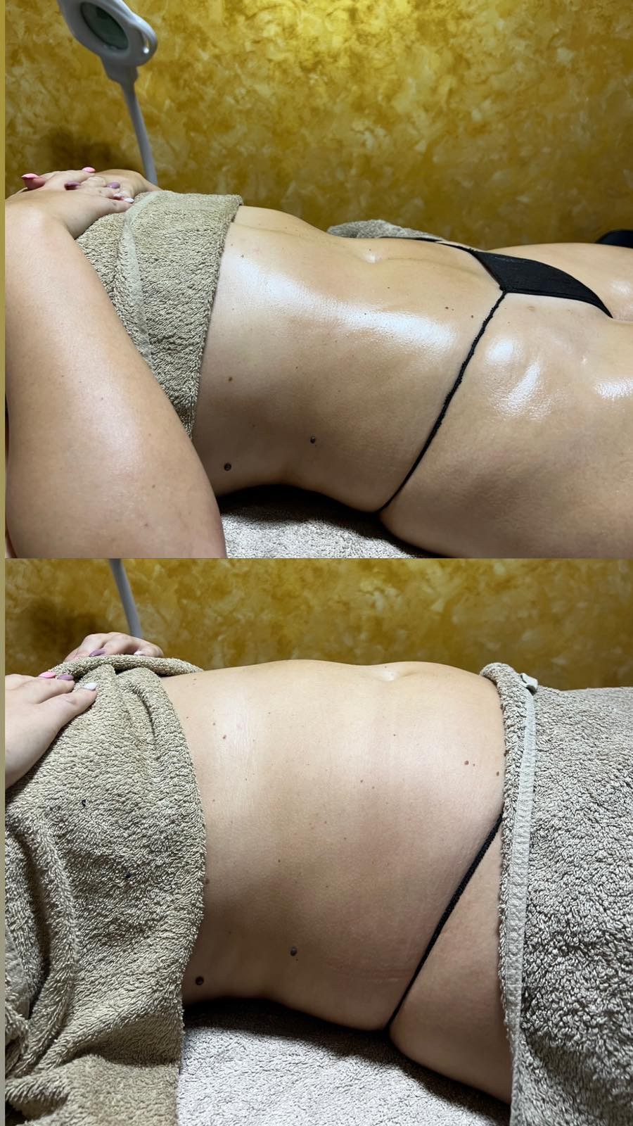 Brazilsko lipomodelovanje - stomak - Zgodnica, Beograd Anticelulit masaža Masaža Anticelulit masaža, Beograd, Jajinci