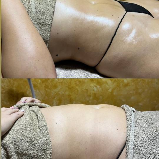 Zgodnica #beograd Anticelulit masaža Brazilsko lipomodelovanje - stomak Brazilsko lipomodelovanje u