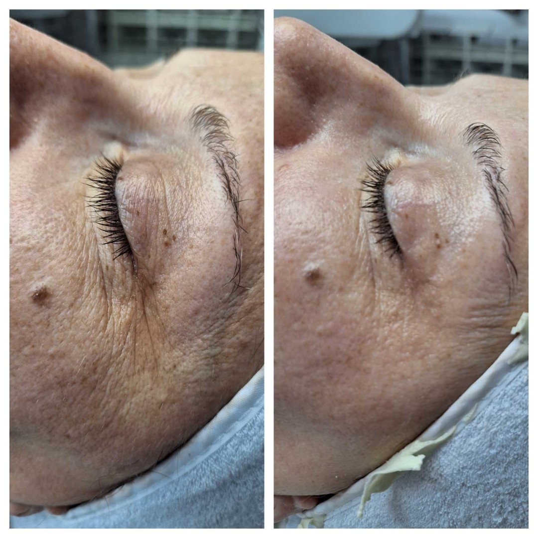 Look at me #beograd Tretmani protiv bora 3D Wrinkle tretman lica