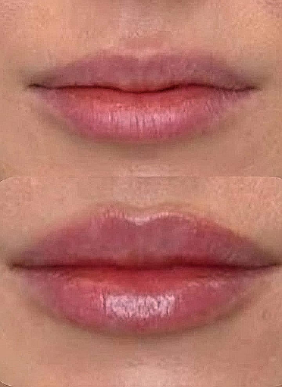 Hijaluronski filer - 0,5 ml - Abrakadabra spa, Beograd Hijaluronski tretmani lica Lice Hijaluronski tretmani lica, Beograd, Vračar, Čubura, Crveni krst
