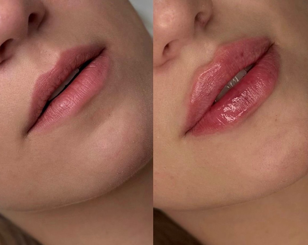 Estetik beauty centar #pancevo Tretman lica Hijaluronski filer iglom-1 cc