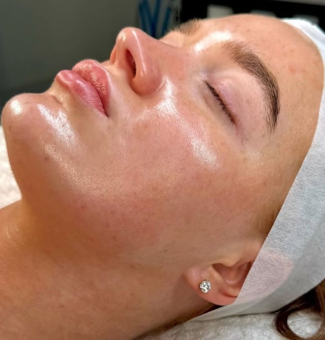 Estetik beauty centar #pancevo Tretman lica Exosomi