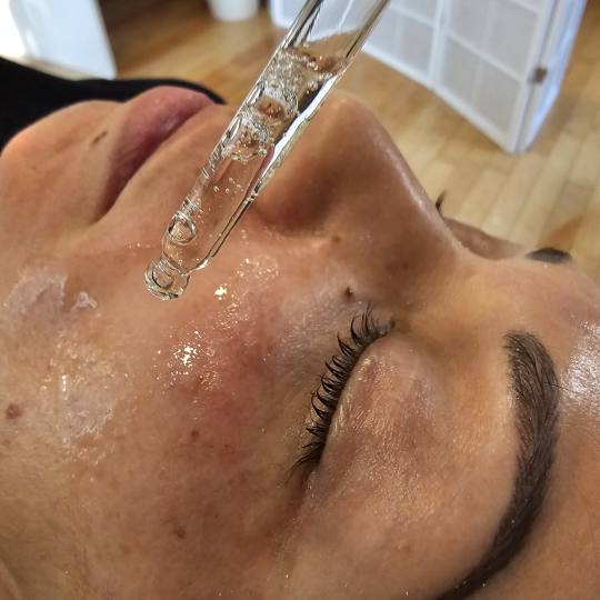 Esthetique Privé #beograd Tretman ožiljaka Dermapen tretman lica
