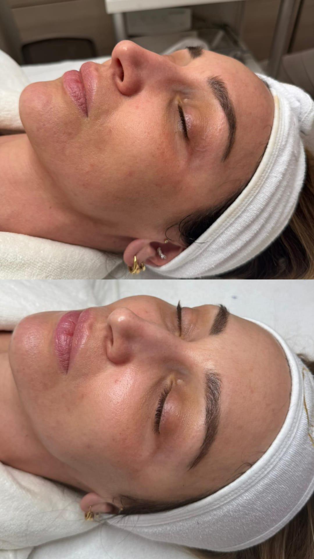 Choco Love #beograd Hijaluronski tretmani lica Oxy tretman lica kiseonikom