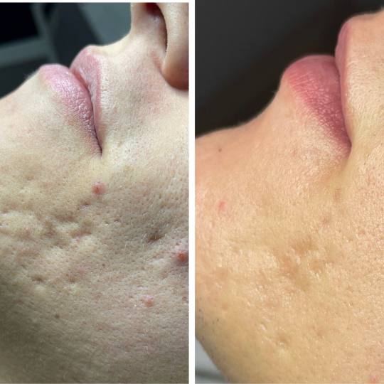 Lancier Beauty Expert #beograd Tretman lica Plazma lift - celo lice