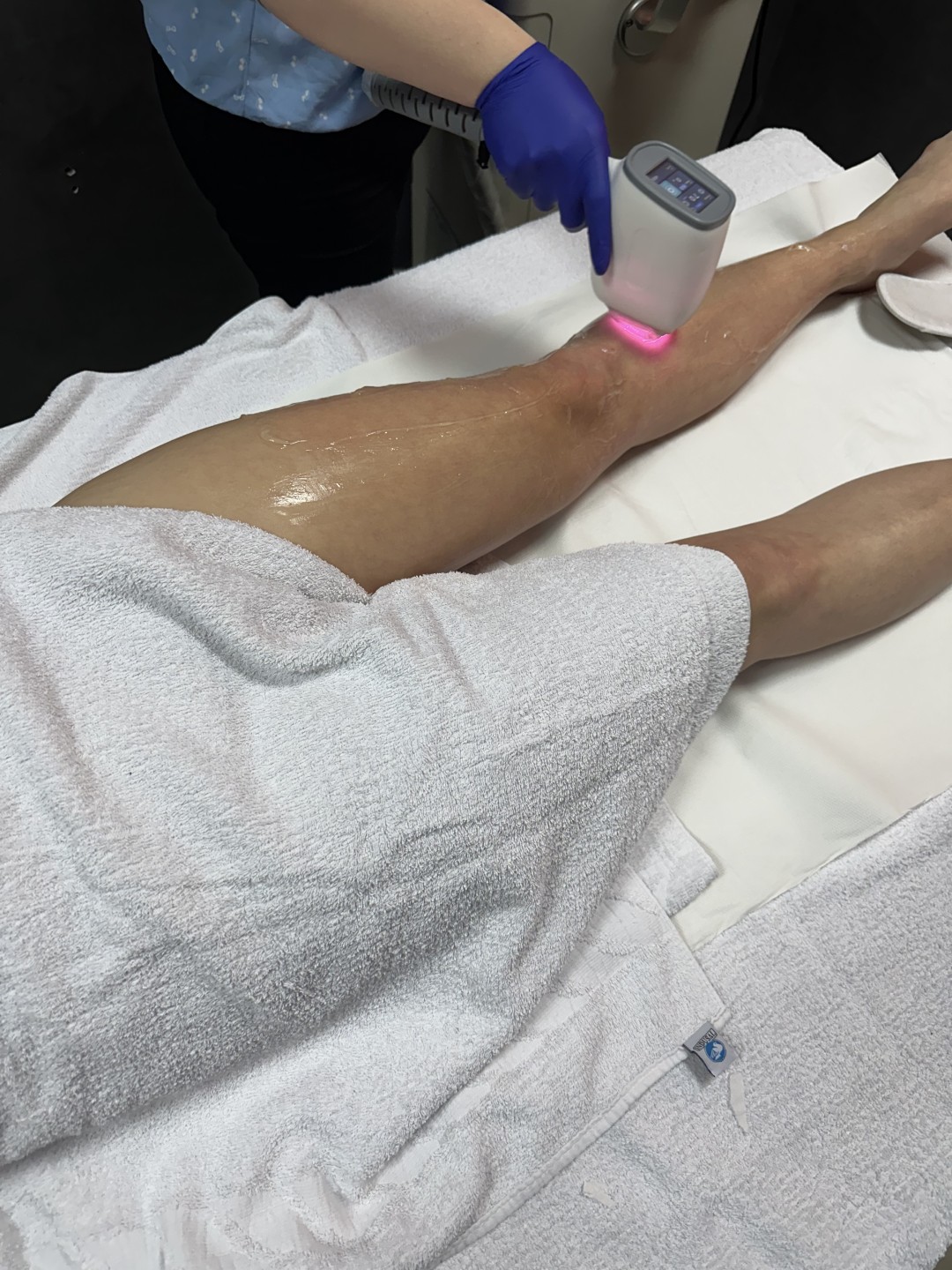 Laser centar Dodoš #beograd Laserska epilacija Laserska epilacija celih nogu - za dame