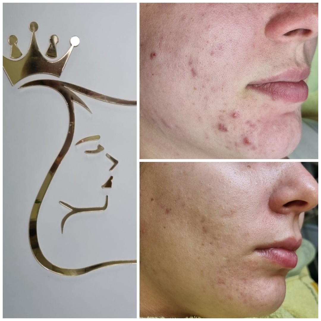 Personalizovani tretman lica - Emilly, Beograd Tretman lica Lice Tretman lica, Beograd, Zvezdara