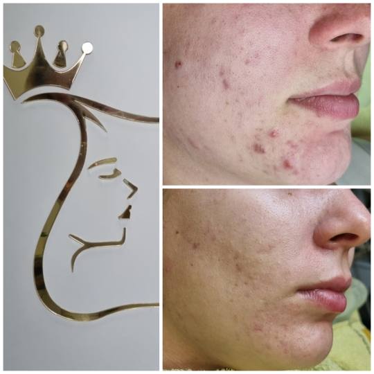 Emilly #beograd Tretman lica Personalizovani tretman lica Higijenski tretman neophodan u rešavanju 