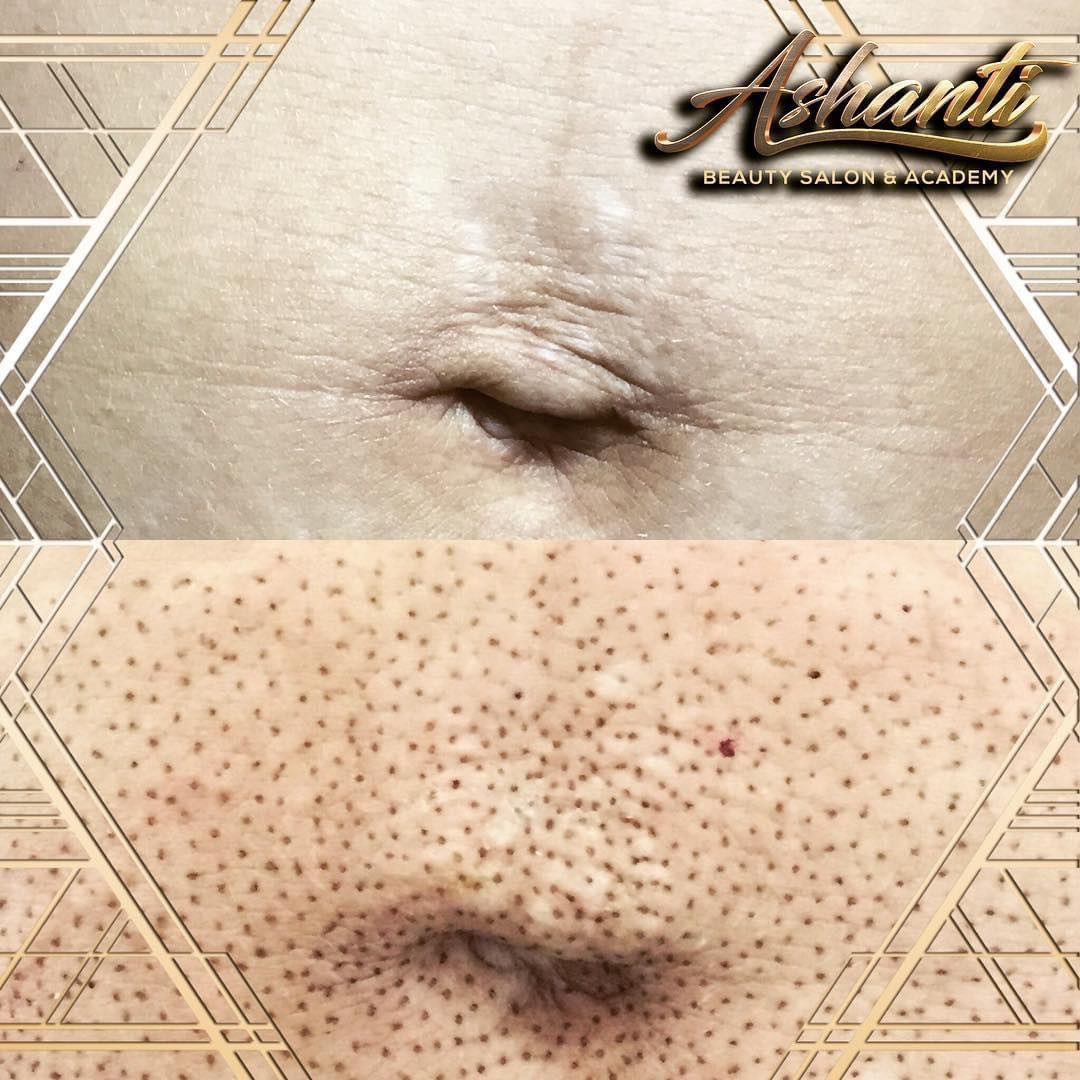 Plasma pen - stomak - Ashanti Beauty Salon & Academy, Beograd Tretman lica Lice Tretman lica, Beograd, Voždovac