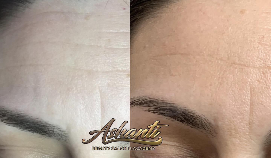 Plasma pen - horizontalne bore čela - Ashanti Beauty Salon & Academy, Beograd Tretman lica Lice Tretman lica, Beograd, Voždovac