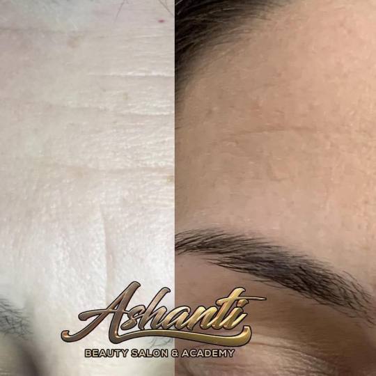 Ashanti Beauty Salon & Academy #beograd Tretman lica Plasma pen - horizontalne bore čela