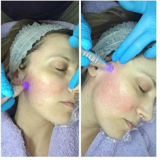 2 Cats 1 #beograd Dermaroler i dermapen Dermapen lice + vrat