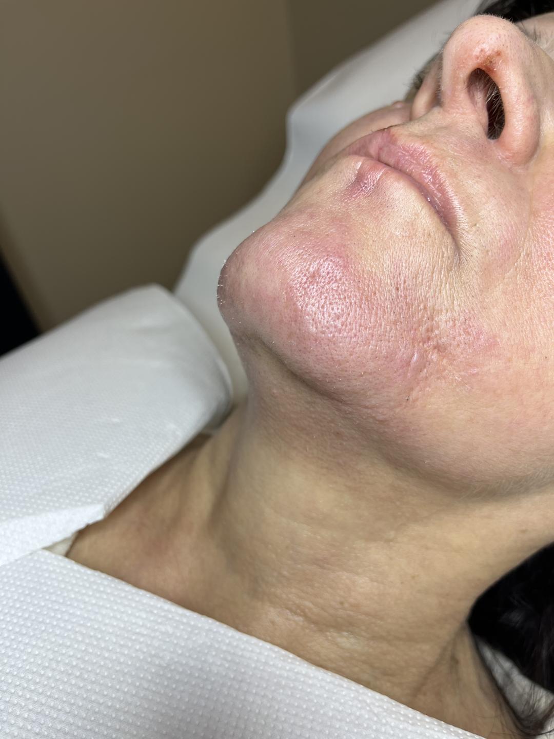 Laser centar Virgo #beograd Laserska epilacija Laserska epilacija celog lica - za dame