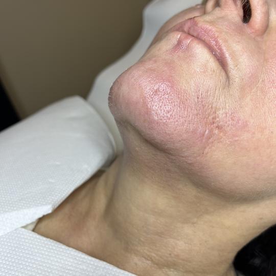 Laser centar Virgo #beograd Laserska epilacija Laserska epilacija celog lica - za dame Neželjene dl