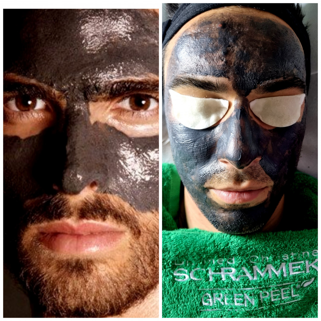 Emilly #beograd Tretman lica Green peel - Black Clear
