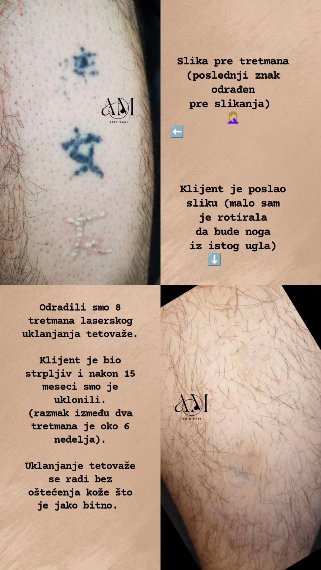 AM BEAUTY STUDIO #odzaci Trajna šminka Uklanjanje tetovaže