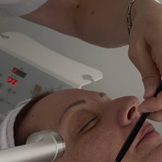 Sandra estetik studio #beograd Tretman lica Mezoporacija lica 💎 Mezoporacija – moderna alternat