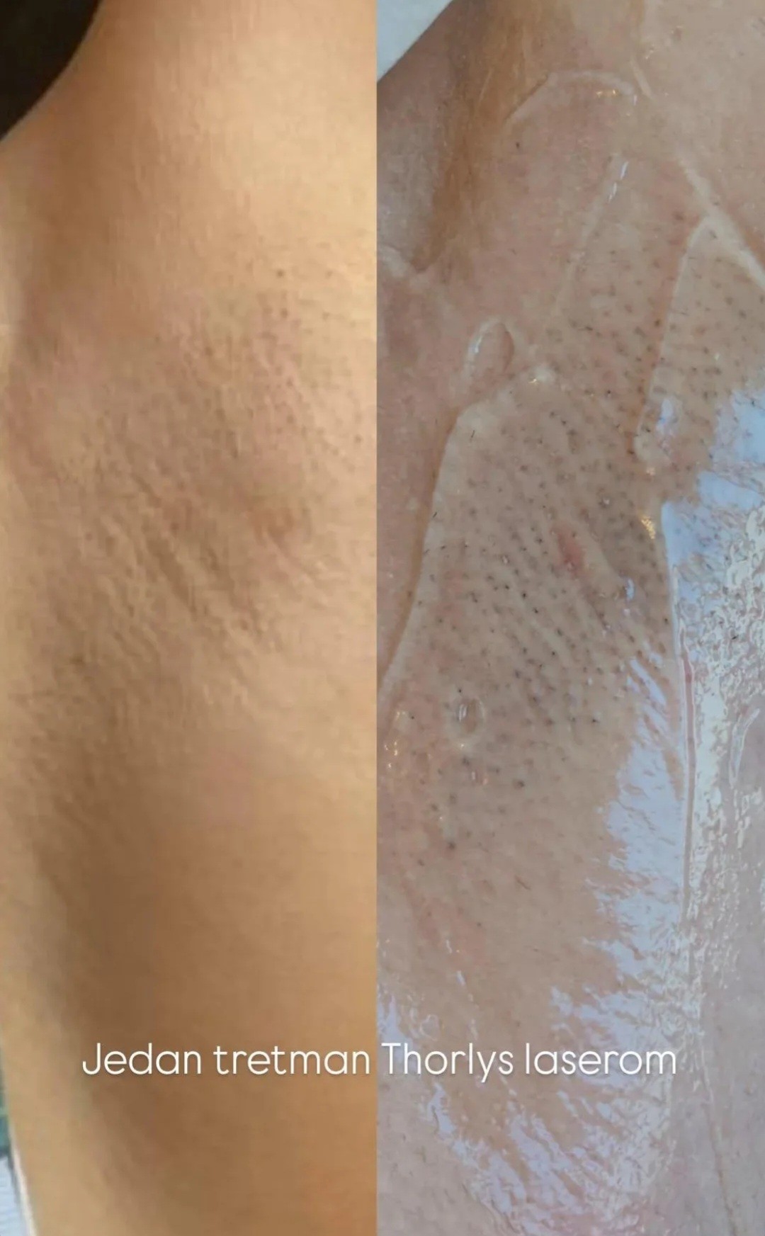 LYS by Royal Beauty Switzerland #nis Laserska epilacija Laserska epilacija pazuha - za dame