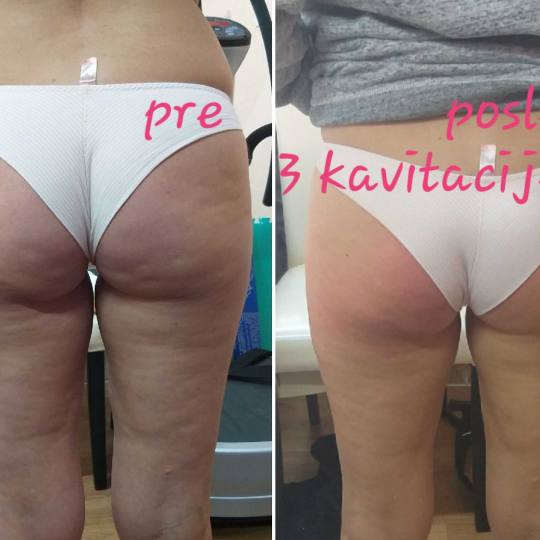 My little secret #beograd Kavitacija Kavitacija