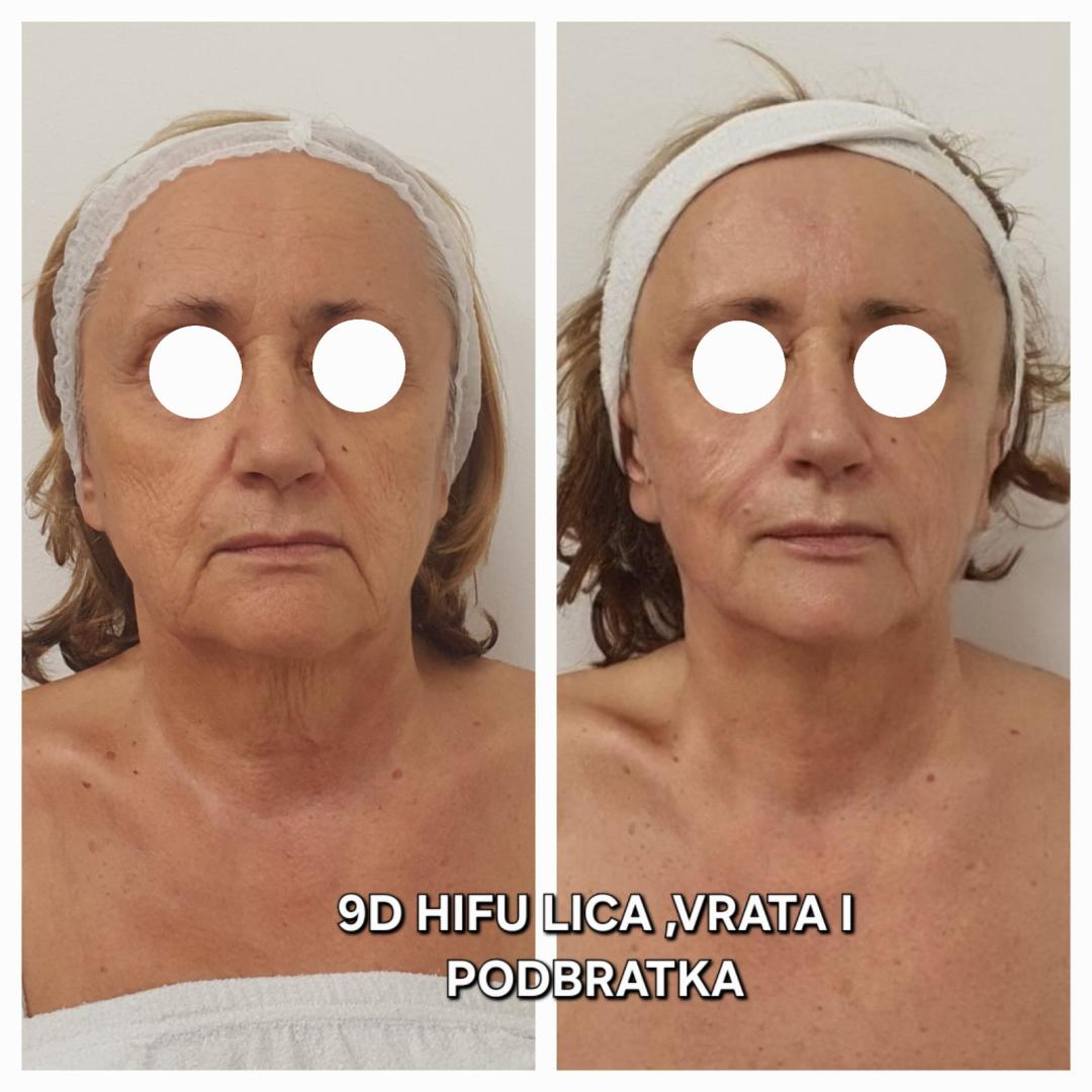 9D HIFU regija oko očiju - Beauty Vreme za mene, Novi Sad Tretman lica Lice Tretman lica, Novi Sad, Sajmište, Detelinara, Banatić