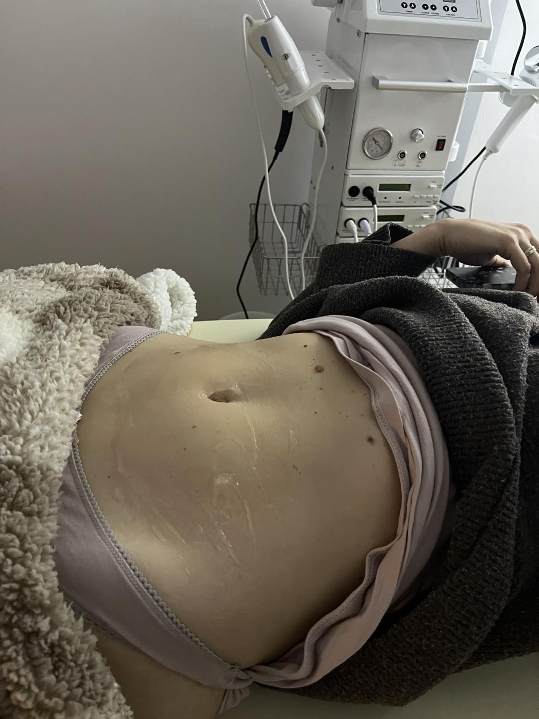 Amelini beauty concept #beograd Tretmani tela Perfect line tretman kavitacija/vakum/rf- 30 minuta