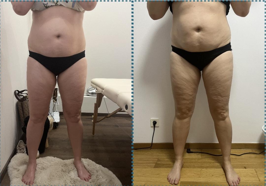 Vacum 65 body + limfna drenaža - Diamond beauty, Beograd Anticelulit masaža Masaža Anticelulit masaža, Beograd, Zemun Centar