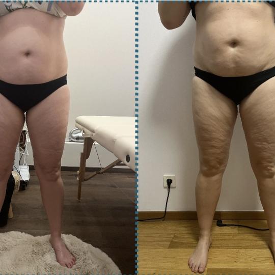 Diamond beauty #beograd Anticelulit masaža Vacum 65 body + limfna drenaža