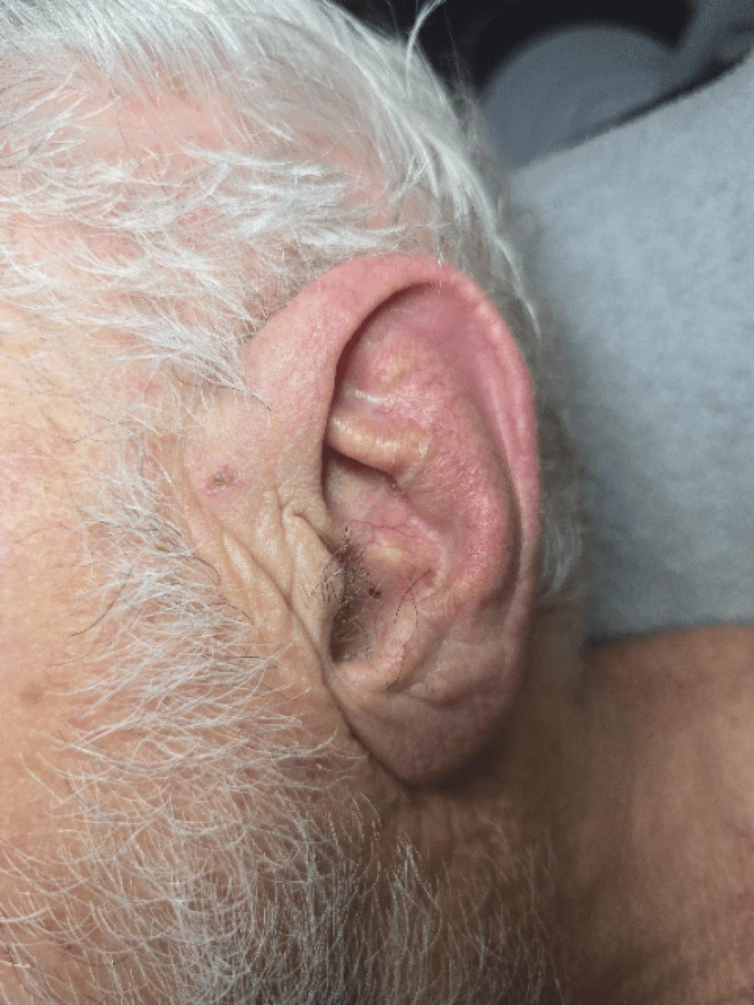 Spago #beograd Depilacija toplim voskom Depilacija ušiju toplim voskom - za muškarce