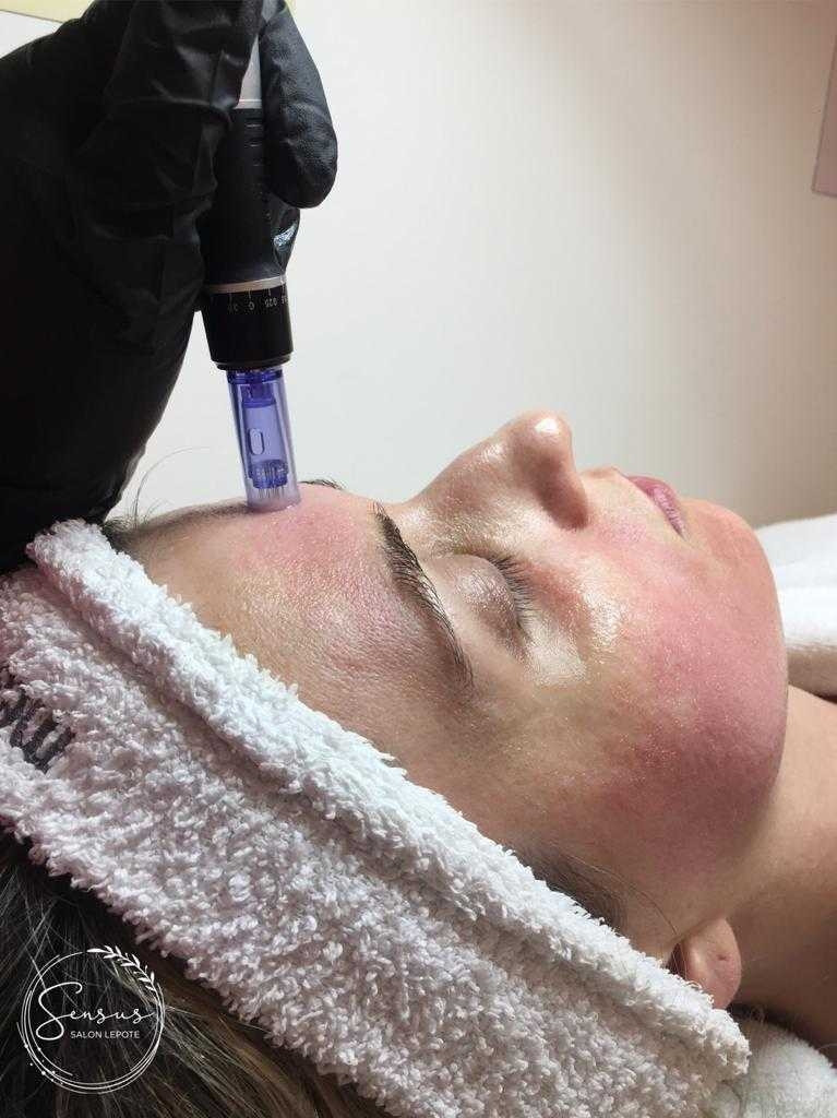 Sensus #beograd Dermaroler i dermapen Dermapen - za hiperpigmentaciju