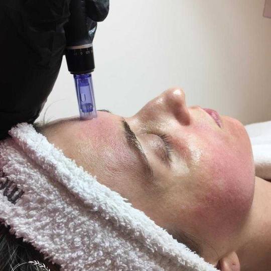 Sensus #beograd Dermaroler i dermapen Dermapen - za hiperpigmentaciju