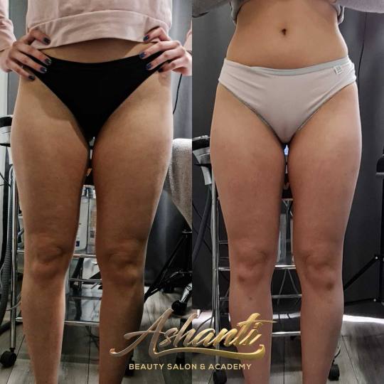 Ashanti Beauty Salon & Academy #beograd Tretmani tela Ultrazvučna kavitacija + vakum sa bipolarnim 