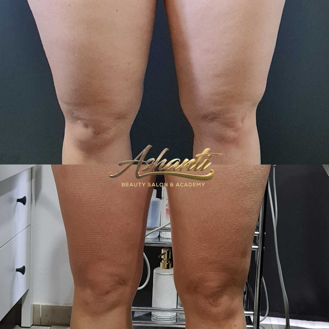 Ashanti Beauty Salon & Academy #beograd Kavitacija Ultrazvučna kavitacija - po regiji
