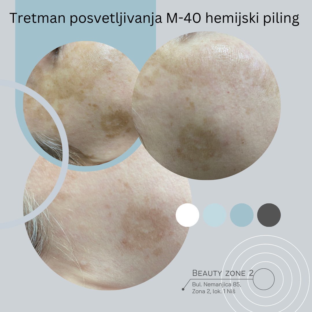 Expert Lab M-40 Hemijski piling - Miljana, Niš Tretman lica Lice Tretman lica, Niš, Medijana