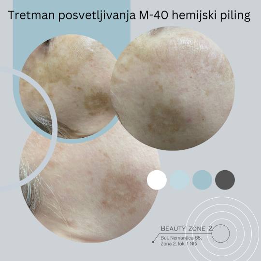 Miljana #nis Tretman lica Expert Lab M-40 Hemijski piling