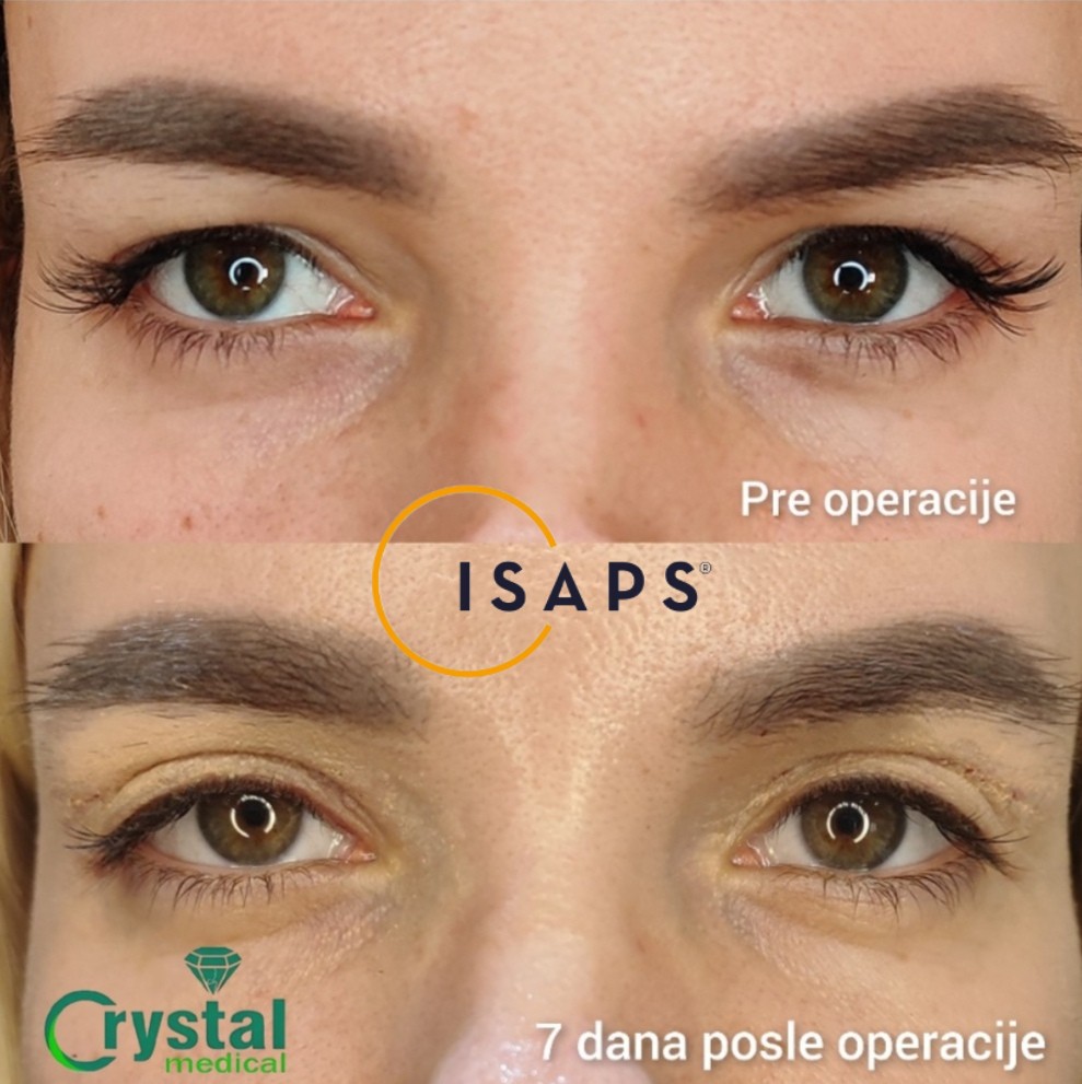 Crystal Medical #beograd Medicinske intervencije Korekcija gornjih očnih kapaka