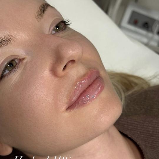 L’Avenue #beograd Mezoterapija lica Hydralips-mezoterapija usana hijaluronom