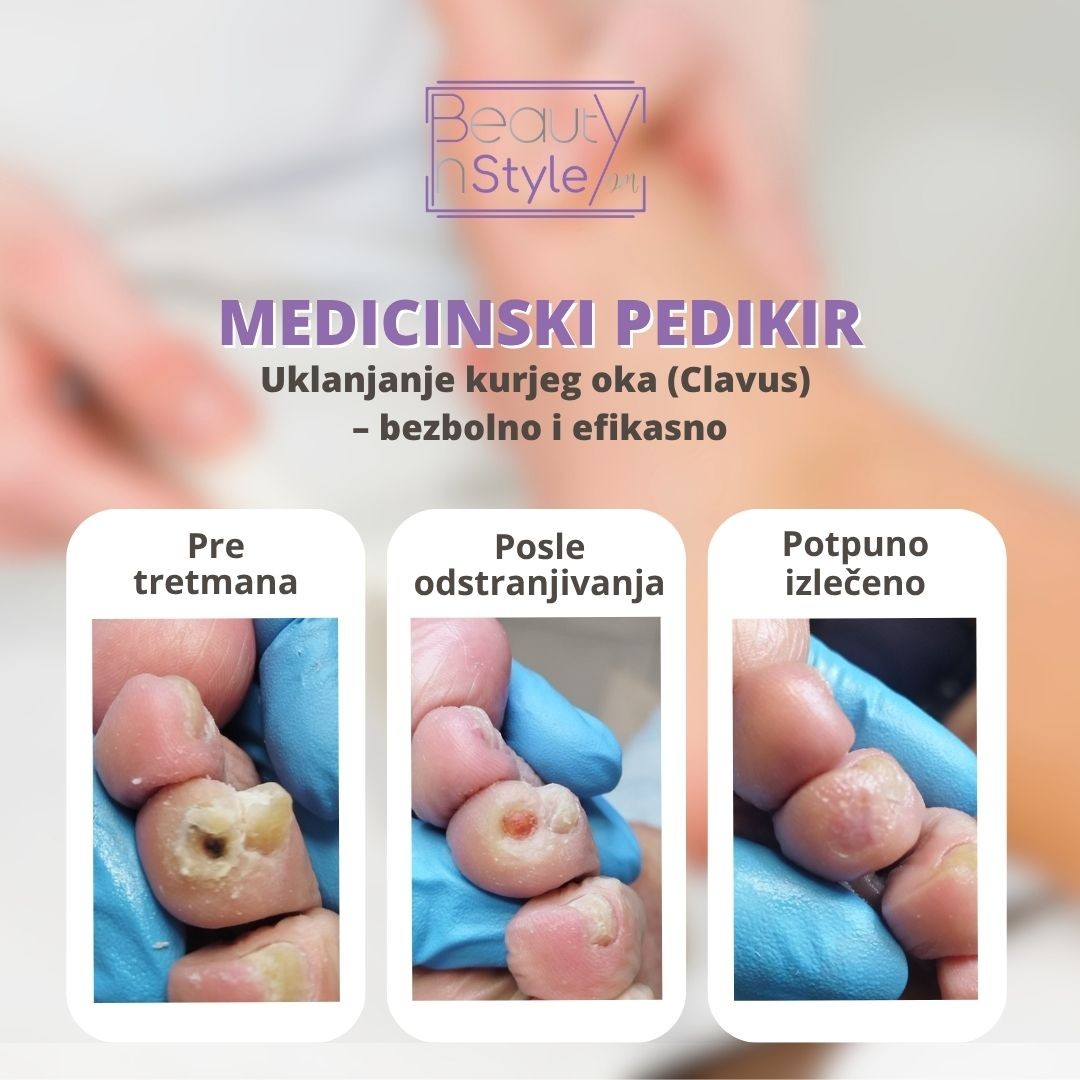 Beauty in Style DM #novisad Medicinski pedikir Medicinski pedikir 2