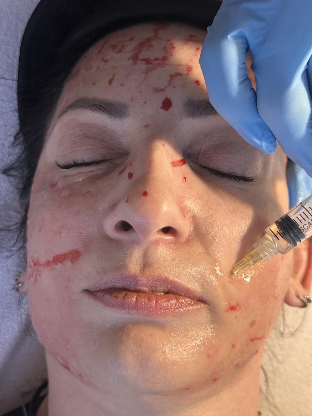 Beauty & Fashion #beograd Tretman lica PRP lica - sa hijaluronskom kiselinom