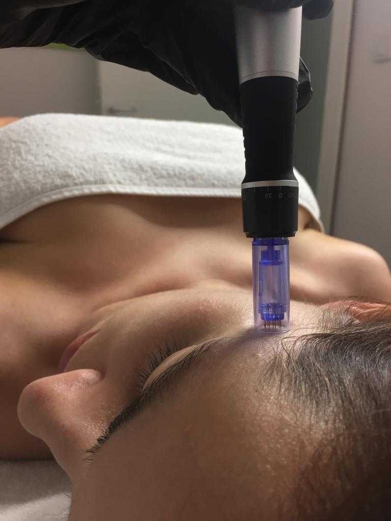 Sensus #beograd Dermaroler i dermapen Dermapen + serum - za biorevitalizaciju