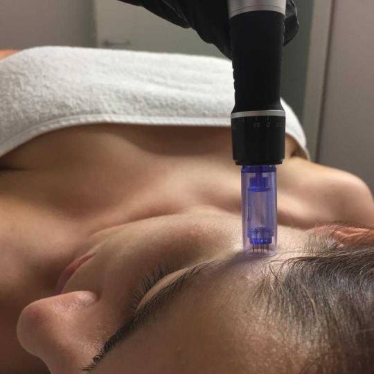 Sensus #beograd Dermaroler i dermapen Dermapen + serum - za biorevitalizaciju