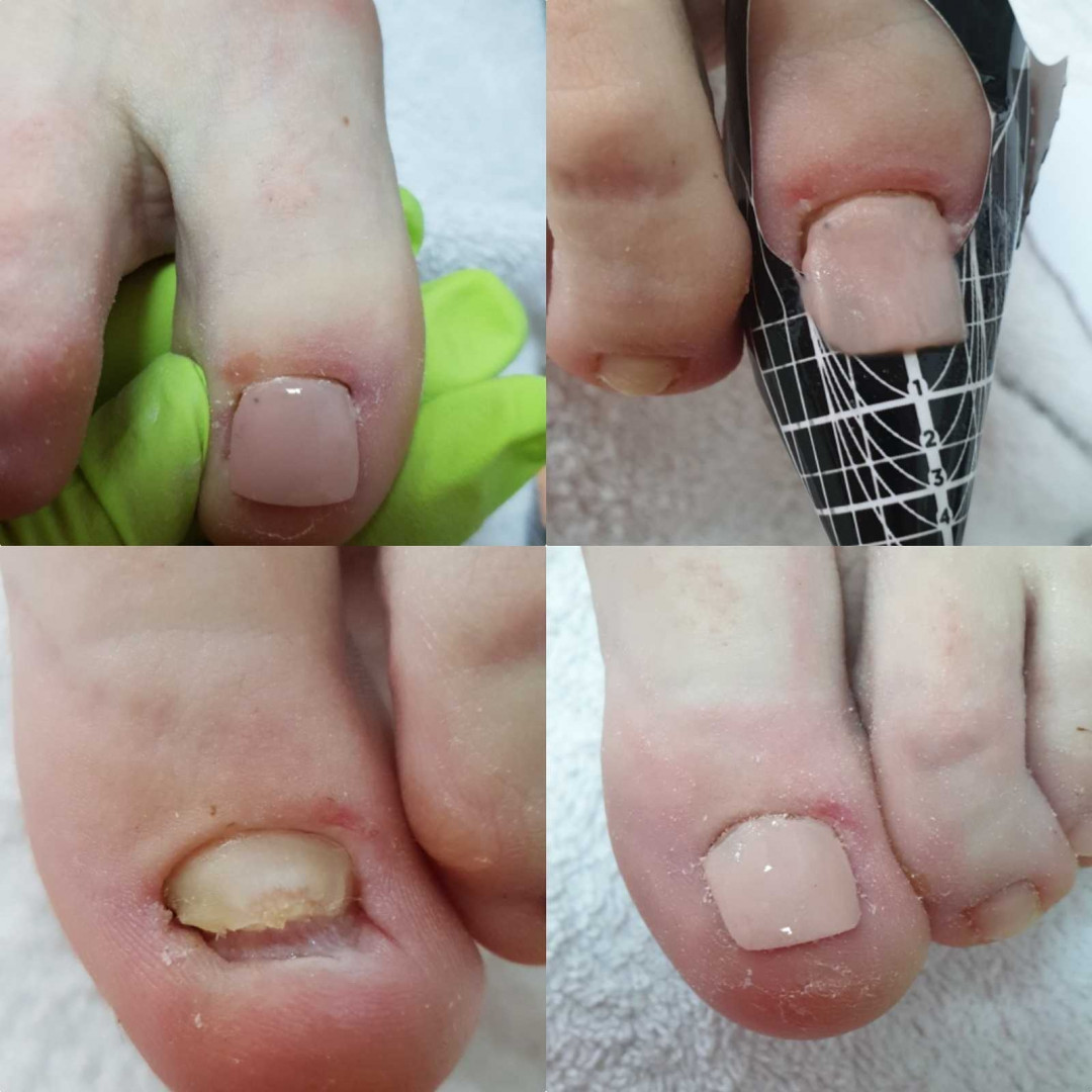 Tina B #beograd Medicinski pedikir Medicinski pedikir - gljivični / oboleli nokti