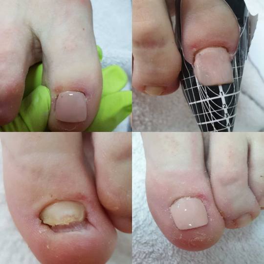 Tina B #beograd Medicinski pedikir Medicinski pedikir - gljivični / oboleli nokti