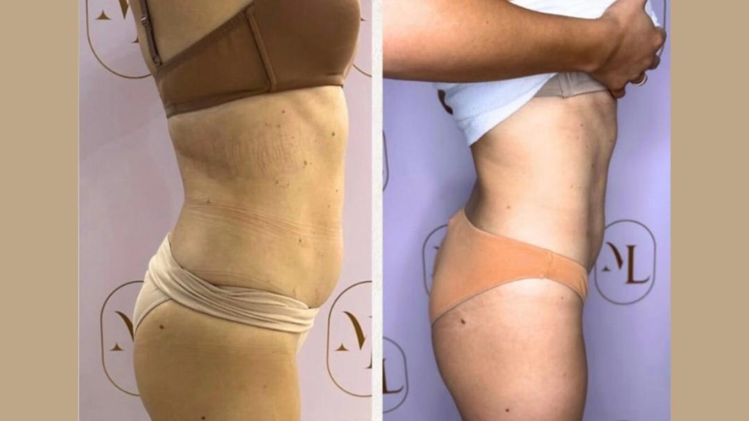 Personalizovani Attento tretmani tela - paket od 8 tretmana - Attento Aesthetic, Beograd Tretmani tela Telo Tretmani tela, Beograd, Zvezdara