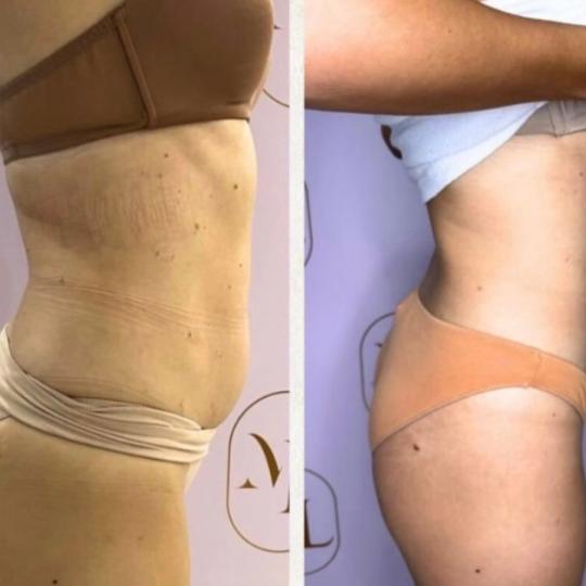 Attento Aesthetic #beograd Tretmani tela Personalizovani Attento tretmani tela - paket od 8 tretmana