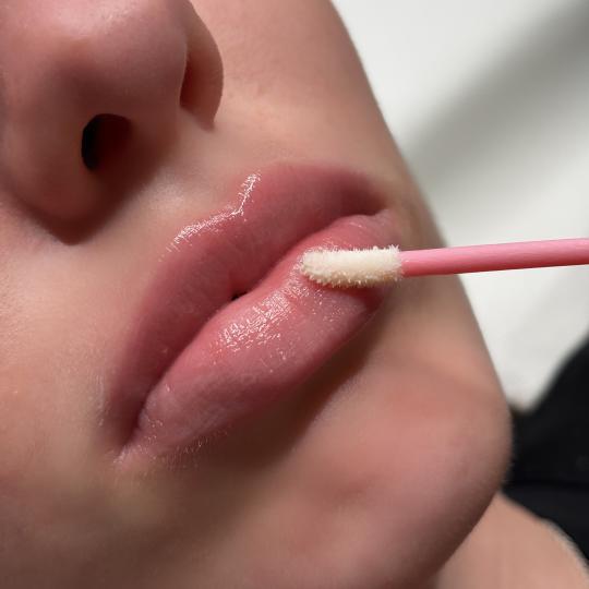 L’Avenue #beograd Mezoterapija lica Hydralips-mezoterapija usana hijaluronom