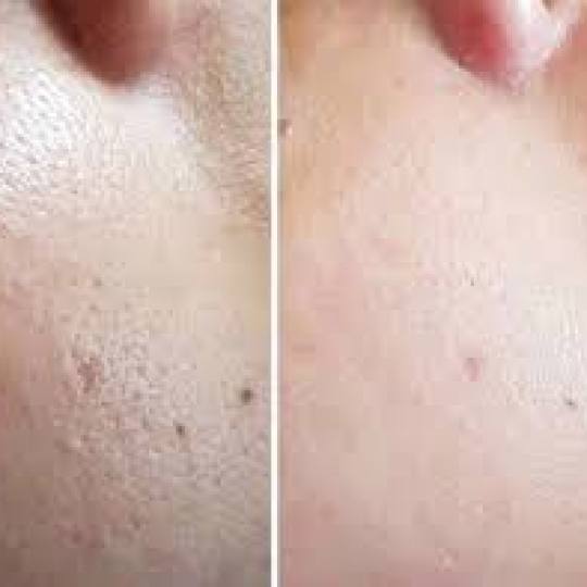 Vila Beauty Studio #beograd Dermaroler i dermapen Dermapen tretman lica